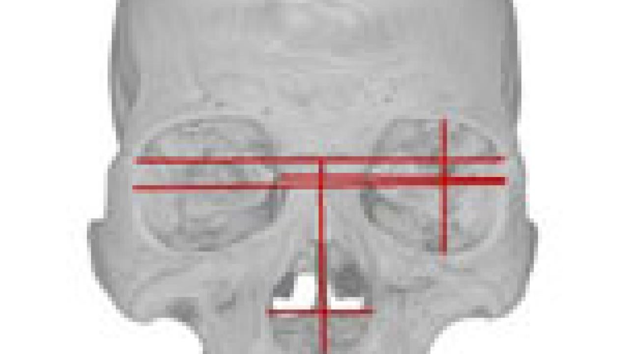 Photo: Threel views of a human skull with measurement links acrossthe eyes and down the nose.