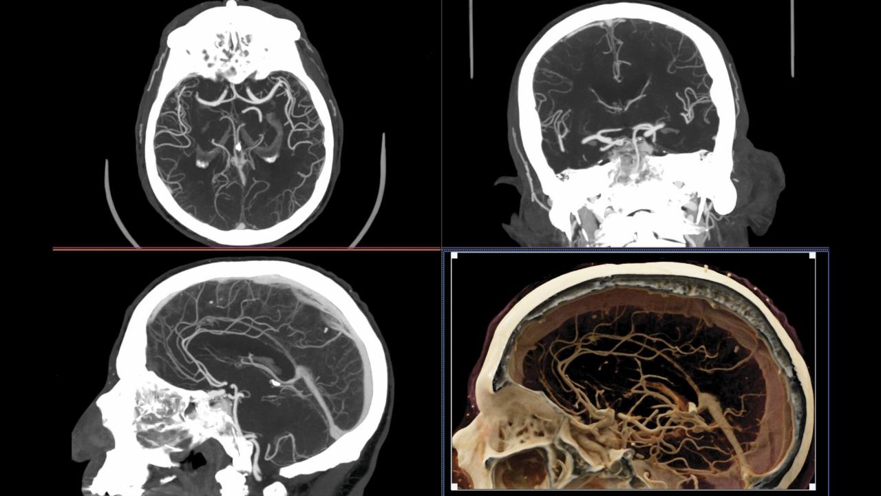 Four images of a human head made by CT imaging. 